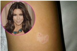 Kim Kardashian blottar sin sjukdom för fansen