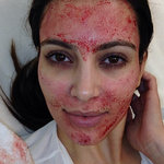 Video! Kim Kardashian får plågsam ansiktbehandling med sitt eget blod!